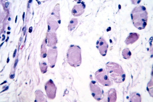 Skeletal muscle atrophy, photomicrograph showing decreased fiber size with increased spacing between them, reduced myofibrils, increased endomysial connective tissue with fatty infiltration