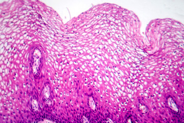 Atypical squamous epithelial hyperplasia, photomicrograph showing thickened stratified epithelium with nuclear atypia and basal layer crowding