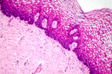 Atypical squamous epithelial hyperplasia, photomicrograph showing thickened stratified epithelium...