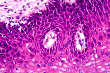 Atypical squamous epithelial hyperplasia, photomicrograph showing thickened stratified epithelium...