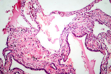 Red hepatization stage of lobar pneumonia, photomicrograph showing alveolar exudate with red cells,...