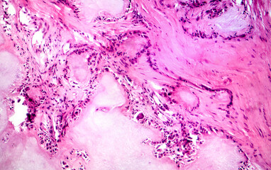 Gout tophus, photomicrograph showing amorphous, eosinophilic material with a foreign-body giant...