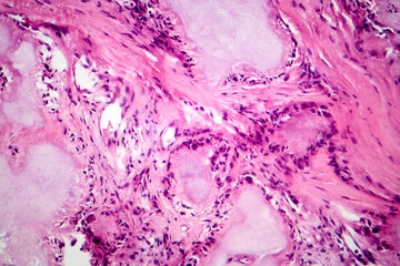 Gout tophus, photomicrograph showing amorphous, eosinophilic material with a foreign-body giant...