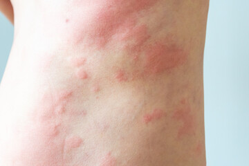 Young asian man itching and scratching on his back from allergic itchy dry skin eczema dermatitis...