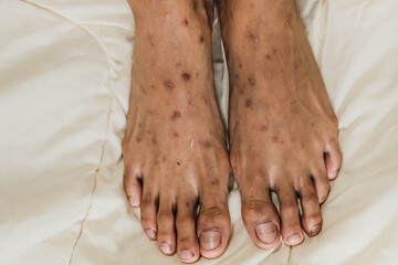 Isolated close-up image of a Southeast Asian female person's feet with black spots on the skin due to mosquito bites and dirty nails on white sheet bed, looking unhygienic
