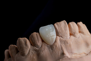 Dental Technician Works High aesthetics
