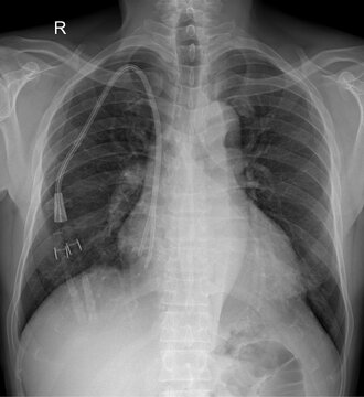 Chest X-ray Showing Central Venous Catheter and ECG Electrodes &ndash; AP View