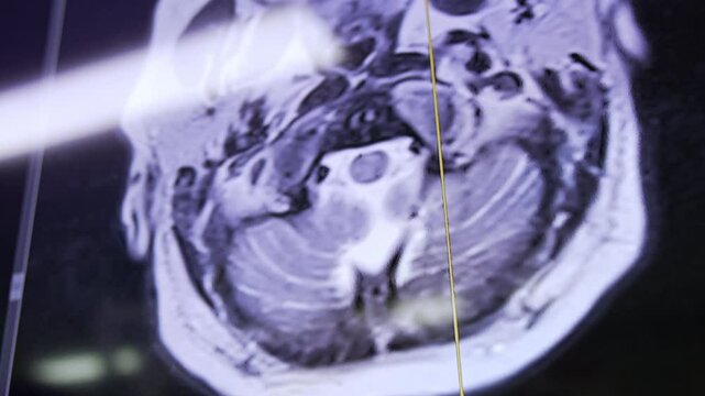 MRI scan of the patient's head. Close up. Neurosurgical operation in hospital.