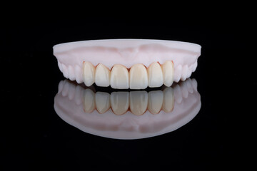 High-quality six dental crowns made of zirconium for fixation to the frontal teeth of upper jaw.