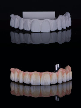 Two stages of making full dental zirconium prosthesis on titanium bar. Dental care concept.