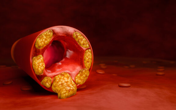 Hyperlipidemia or arteriosclerosis. Blocked artery concept and human blood vessel as a disease with cholesterol fat buildup clogging. Clogged arteries, Cholesterol plaque in the artery. 3D Rendering
