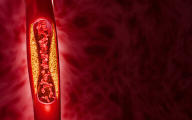 Hyperlipidemia or arteriosclerosis. Blocked artery concept and human blood vessel as a disease with cholesterol fat buildup clogging. Clogged arteries, Cholesterol plaque in the artery. 3D Rendering