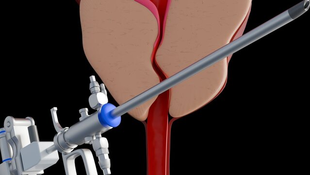 A 3d rendering of resectoscope and benign prostatic hyperplasia or BPH, the prostate gland enlarges.