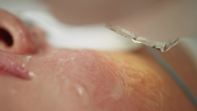 Macro video of removing pigment spots in cosmetology. High quality 4k footage