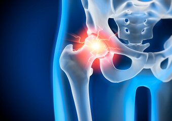 Hip joint inflammation with pain symptom - 3D Rendering