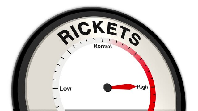 Rickets text or word shown with a barometer or tachometer-style gauge, representing varying levels of severity in bone softening, growth disturbances, associated symptoms due to vitamin D deficiency