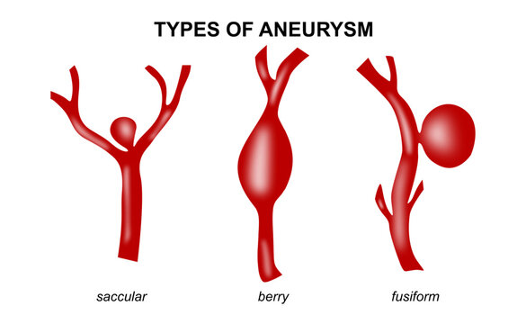 Types of Aneurysm Illustration Brain