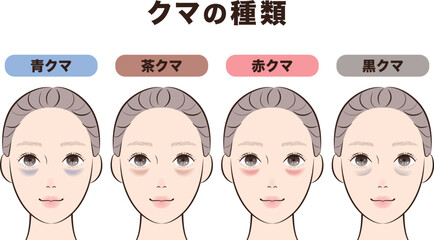 目の下のクマ4タイプ比較｜美容・スキンケア解説用イラスト