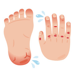 アカギレやヒビ割れなどの炎症を起こした足裏と手の甲のイラスト