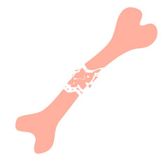 Broken bone illustration