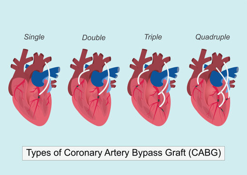 Types of Bypass surgery (Coronary Artery Bypass Grafting or CABG)
