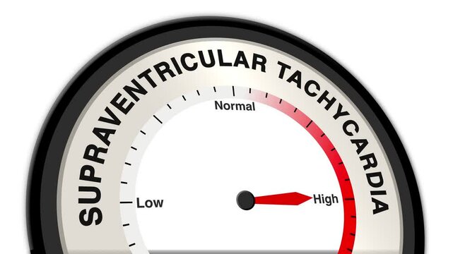Supraventricular Tachycardia text or word with a barometer or tachometer-style gauge, illustrating varying levels of heart rate and severity of the condition