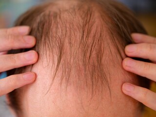 Fototapeta premium Man showing hair loss on his head.