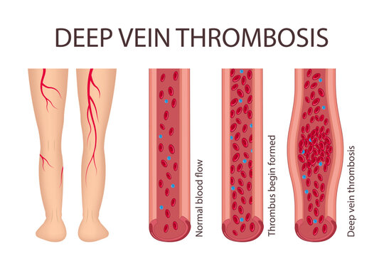 Medical diagram of deep vein thrombosis in the leg area. Illustration of blood flow disorder