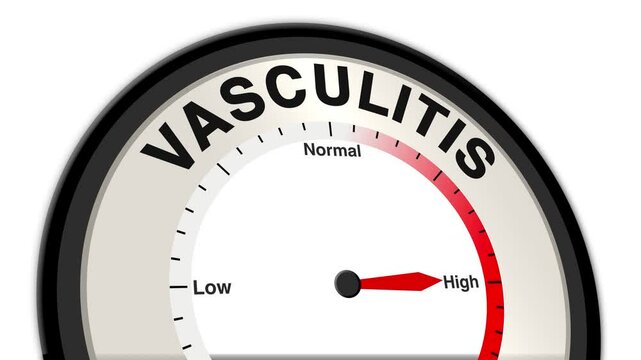 Vasculitis text with a barometer or tachometer-style gauge, illustrating varying levels of severity and inflammation in blood vessels
