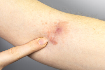 Naklejka premium Woman showing purulent abscess with irritation and dermatitis on hand. Staphylococcus inflammation. Close up, medical photo.