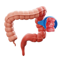 Indicating ulcerative colitis. 3D illustration