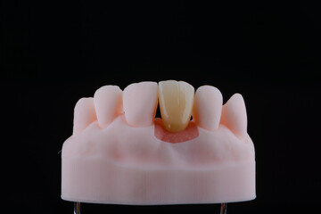 Mirror copy of central maxillary incisor, zirconia crown on titanium abutment fixed on printed model