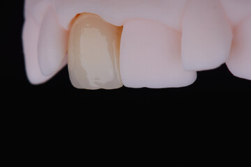 Mirror copy of central maxillary incisor, ultra thin dental ceramic veneer or crown on printed model