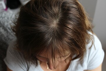 Fototapeta premium Severe Woman Scalp Hair Loss Pattern Women Hairloss Background Image 