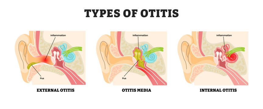 Different types of otitis types, educational medical poster design healthcare scheme, labeled external otitis, otitis media and internal otitis. Ear canal infection or inflammation tinnitus.