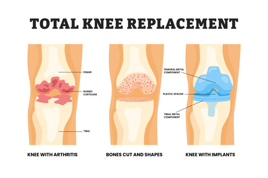 Different types of total knee replacement types, educational medical poster design healthcare scheme, labeled knee with arthritis, bones cut and shapes, knee with implant. Vector illustration.
