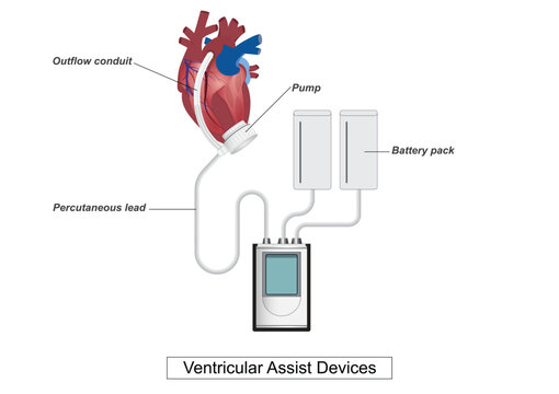 A Ventricular Assist Device (VAD) is a mechanical pump.