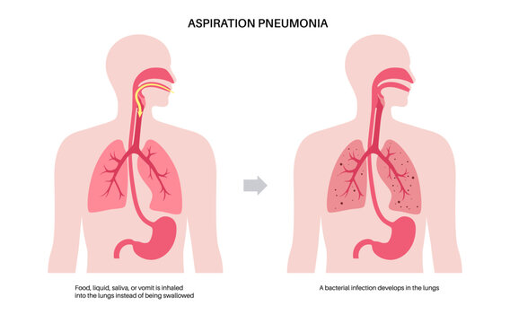 Aspiration pneumonia poster