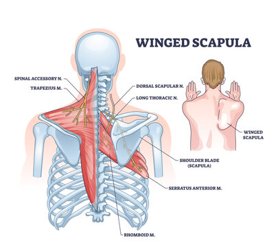 Winged scapula diagram shows shoulder blade protrusion, highlighting muscles and nerves, transparent background.