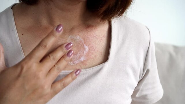 close-up of a woman&rsquo;s hand applying cream to soothe rash and redness on her neck, providing relief from an allergic reaction or skin