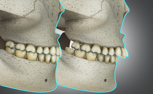 Overbite or a skeletal class II malocclusion before and after illustration.Medically approved.