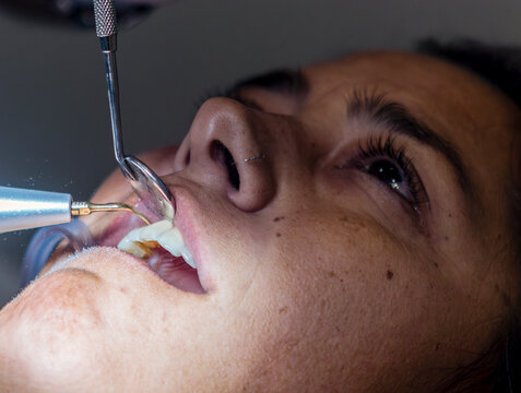 Teeth Cleaning, Close up of Patient Receiving Treatment