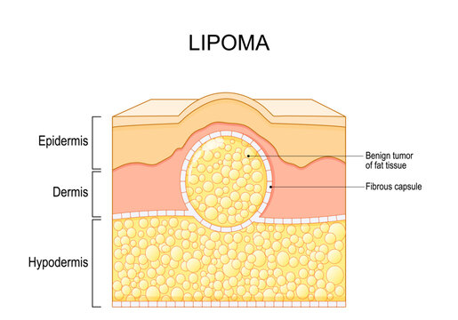 Lipoma. Cross section of a human skin with a fatty lump
