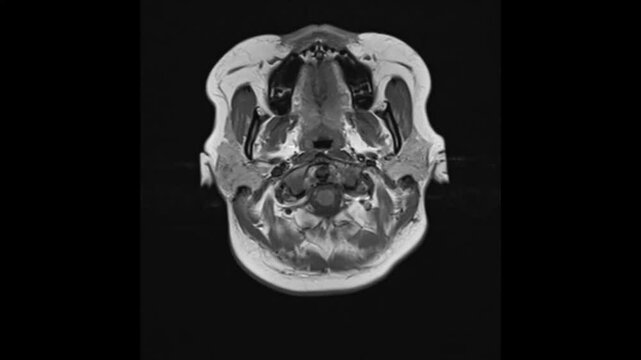 normal brain MRI 