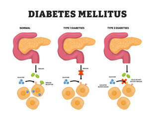 Difference between type one diabetes and type two diabetes, pancreas anatomy insulin diabetes mellitus types, educational medical poster design healthcare scheme, labeled normal and damaged pancreas.