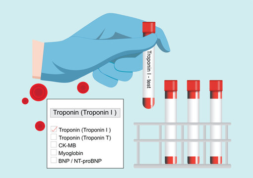Troponin I is a highly specific and sensitive biomarker.