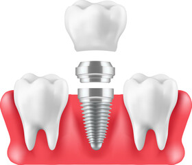  teeth with dental implant in gums over white background