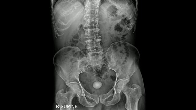 Abdominal and Pelvic X-ray (Supine View) Showing Lumbar Spine, Bowel Gas Pattern, and Pelvic Bones &ndash; Clinical Diagnostic Radiograph