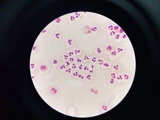 The slide shows a large number of white blood cells, appearing as round or irregularly shaped cells...