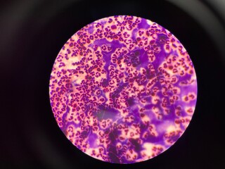 The slide shows a large number of white blood cells, appearing as round or irregularly shaped cells with distinct nuclei. These cells are scattered across the field.